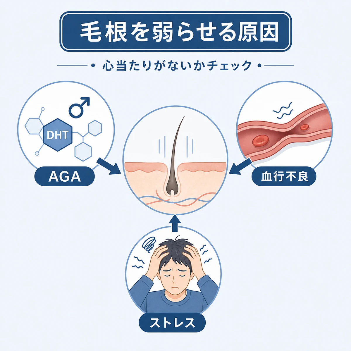 AGAと血行不良とストレスが毛根に影響する関係を結んだ相関図の医療イラスト