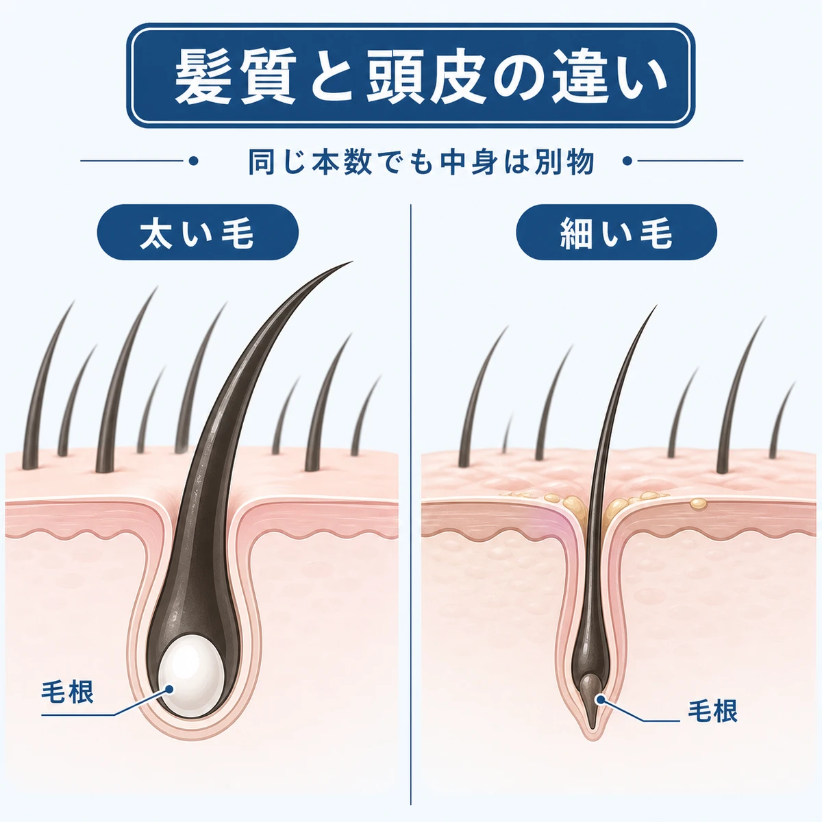 太い毛と細い毛で毛根や頭皮の状態が異なることを比較した医療イラスト