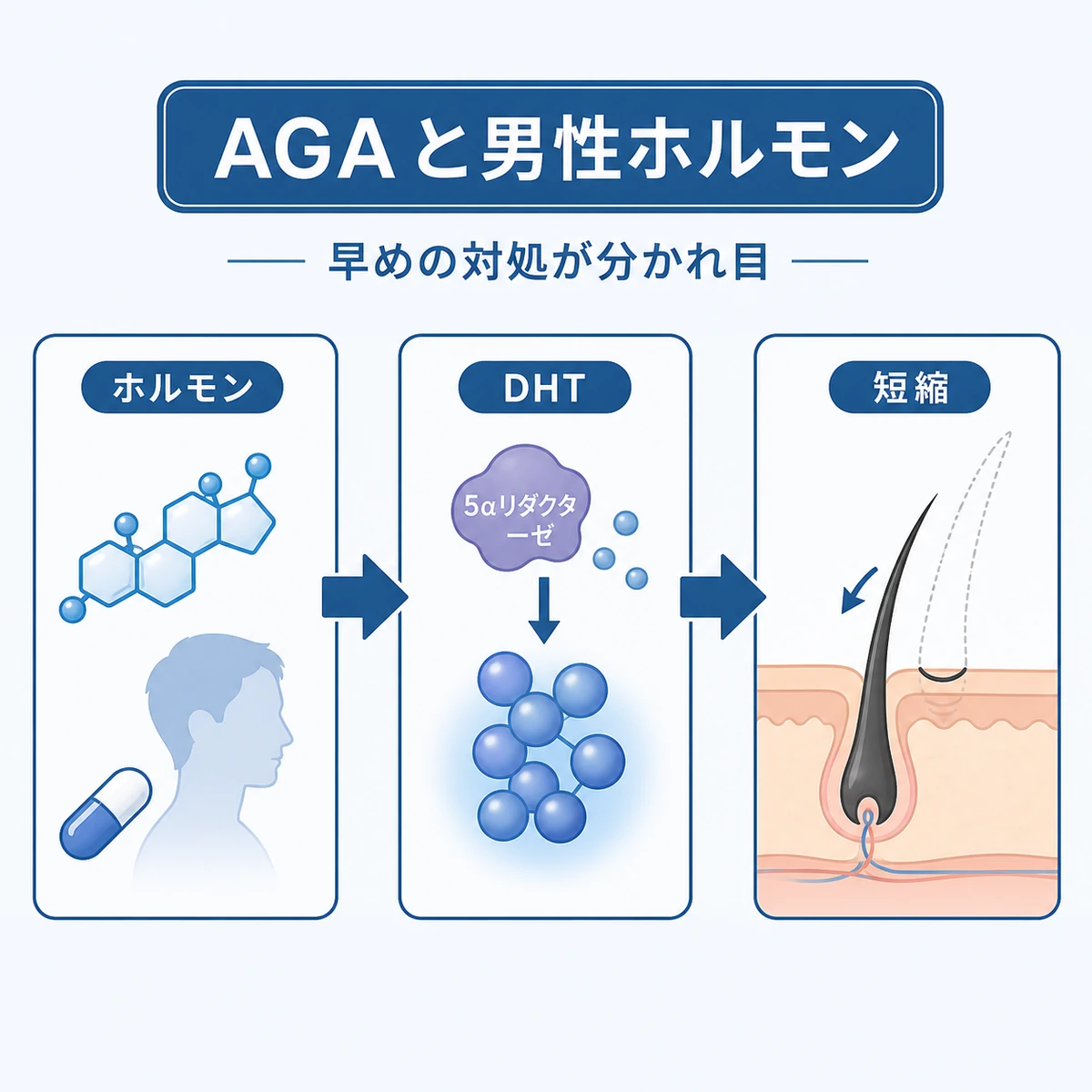 男性ホルモンからDHTが作られ髪の成長期が短くなるAGAの流れを表した医療イラスト