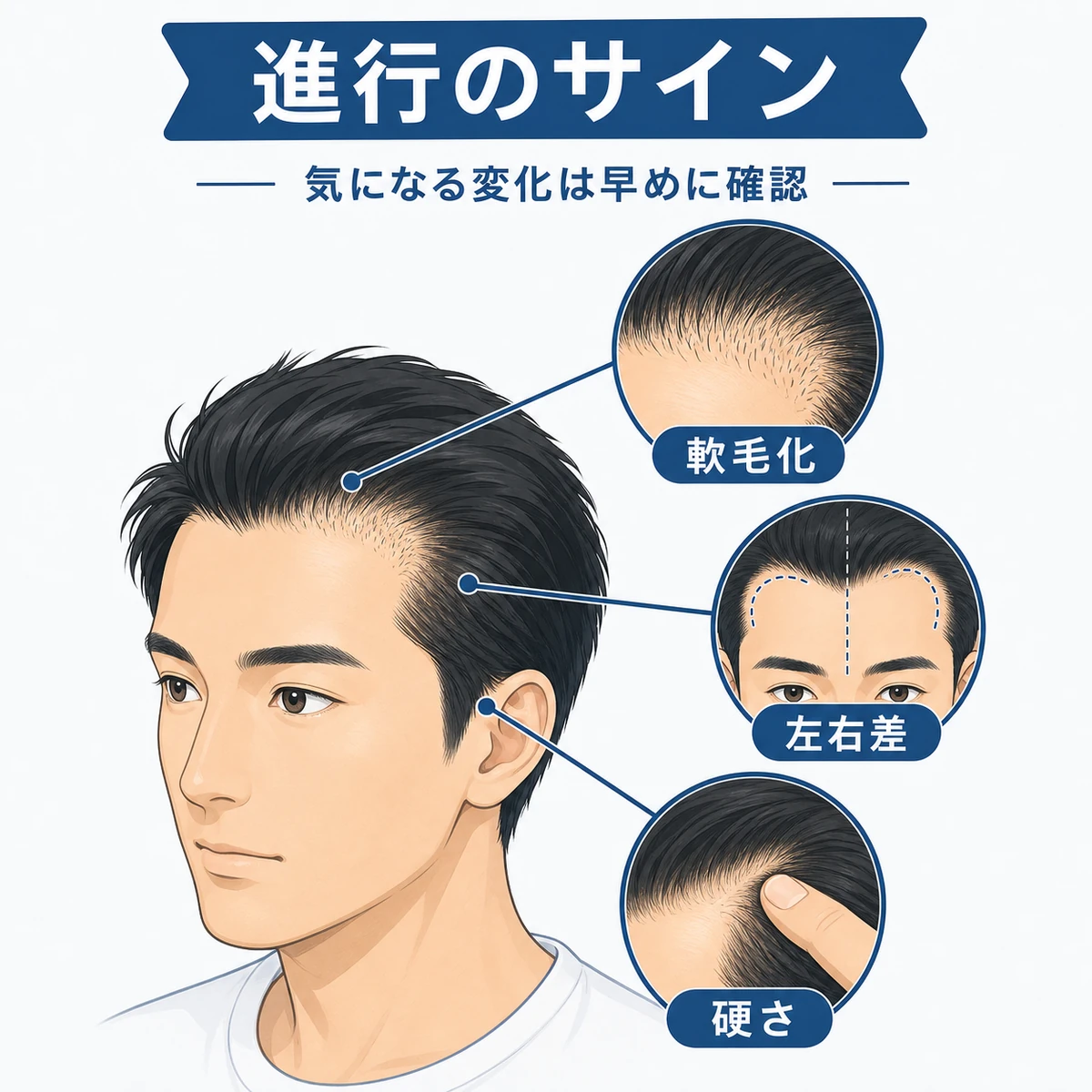 軟毛化や左右差など生え際後退の兆候を頭部から引き出して並べた医療イラスト