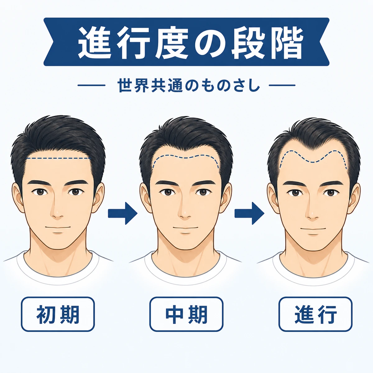 生え際の後退が初期から進行へ進む流れを矢印で示した医療イラスト