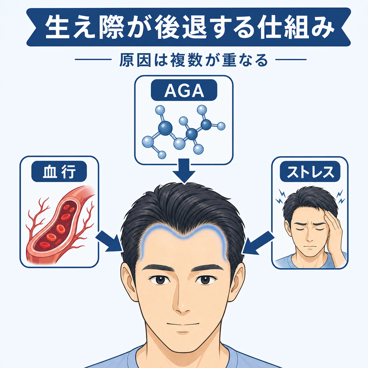 成人男性のM字部分に複数の原因が重なって生え際が後退する仕組みを表した医療イラスト