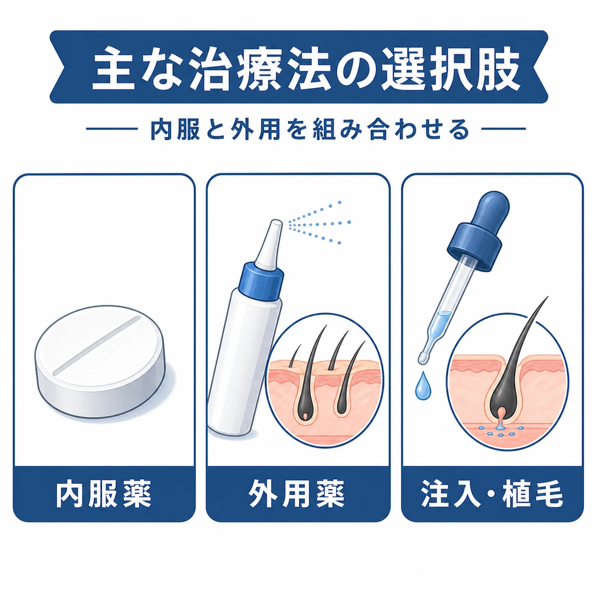 内服薬・外用薬・注入や植毛というAGA治療の選択肢を分類して表した医療イラスト