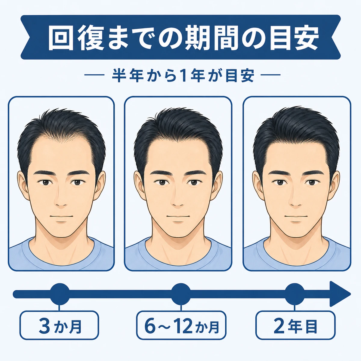 治療開始からの時期ごとに成人男性の生え際が整っていく回復の流れを表した医療イラスト