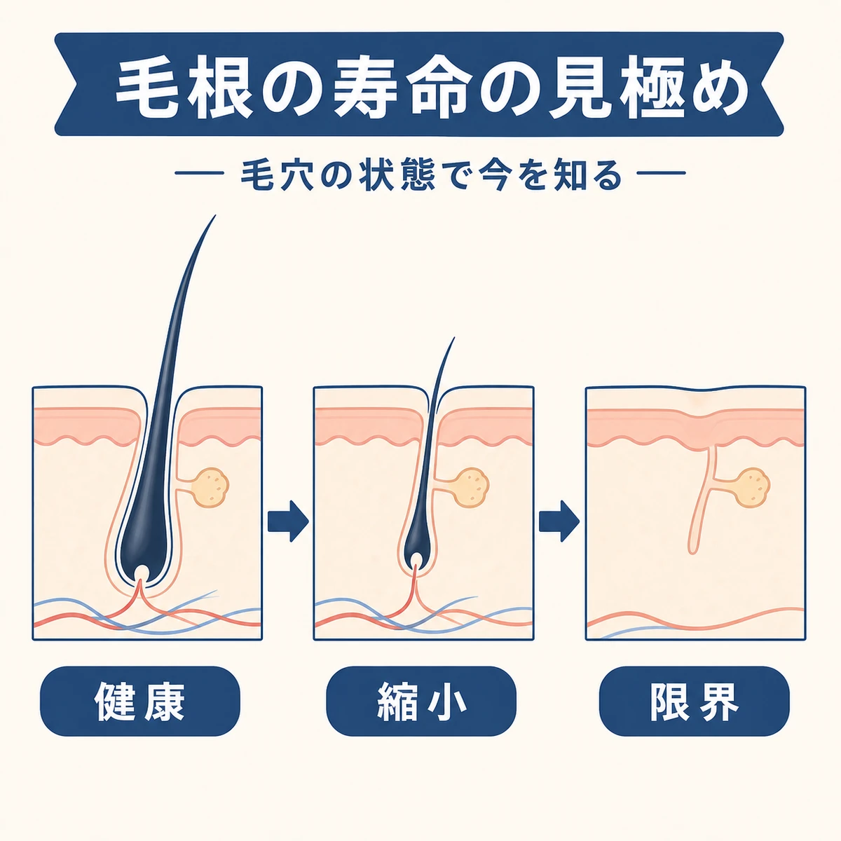 毛穴が健康な状態から縮小し限界へ向かう段階を表した医療イラスト