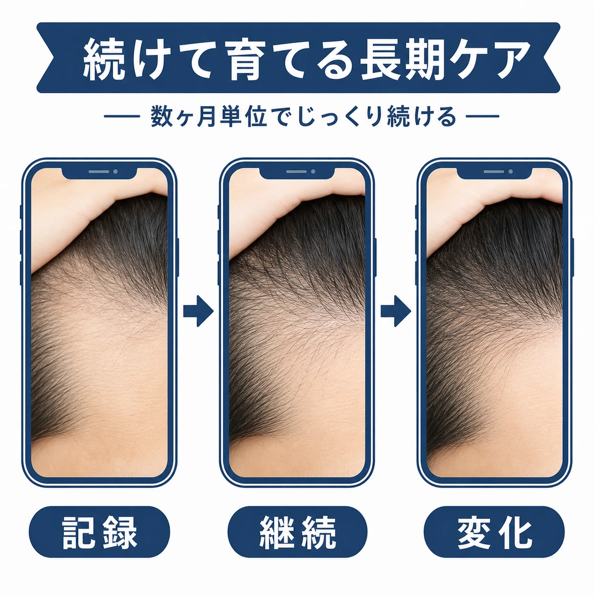 写真記録を続けながら産毛が太い髪へ育つ長期的な経過を表した医療イラスト