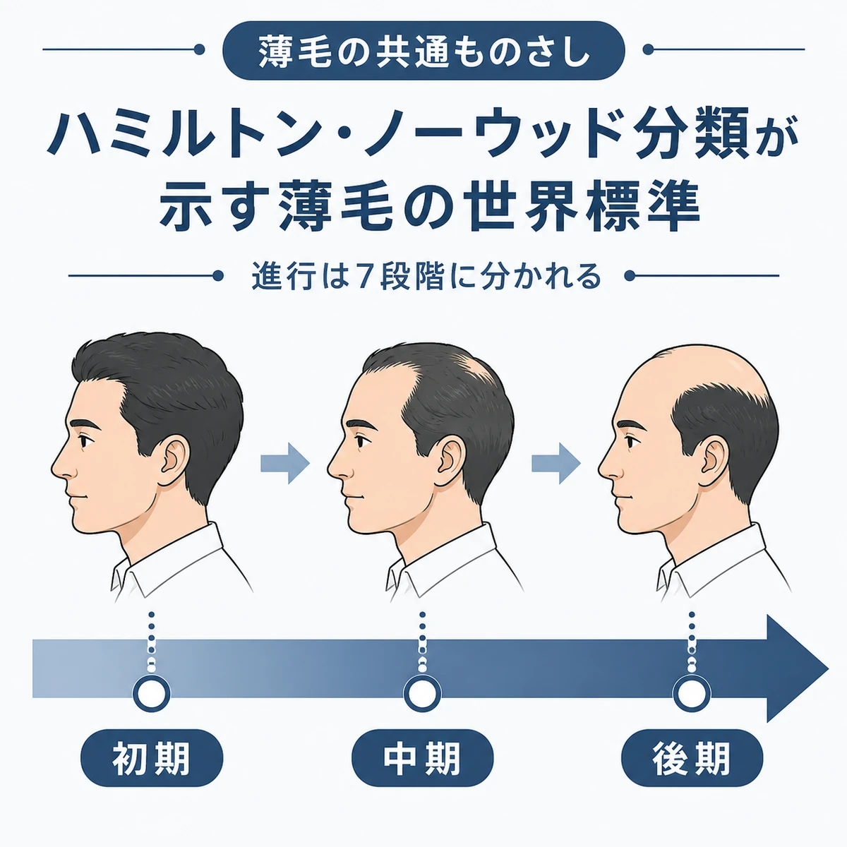 薄毛が初期から後期へ7段階で進む流れを示した医療イラスト