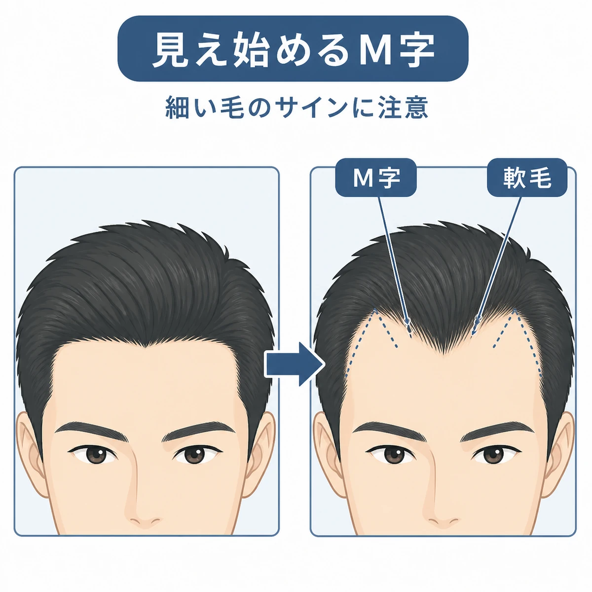 正常な生え際とM字が始まった生え際を並べて比べた医療イラスト