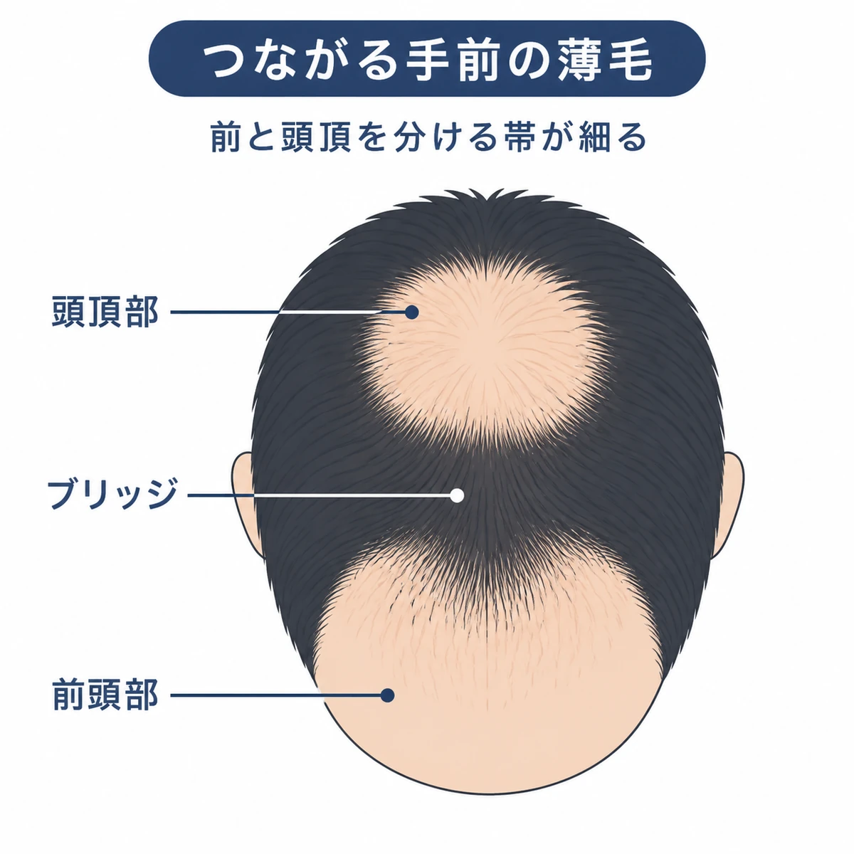 頭頂部から見て前頭部と頭頂部の薄毛がブリッジで隔てられた状態を表した医療イラスト