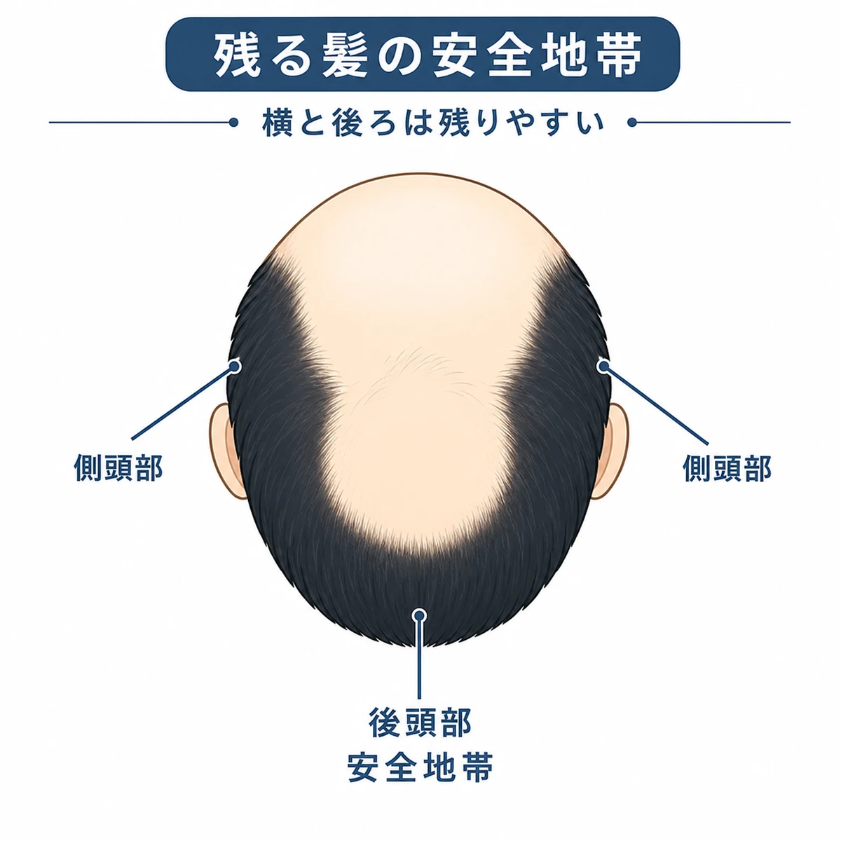 頭の周囲に蹄鉄の形で髪が残る後期の毛髪分布を表した医療イラスト