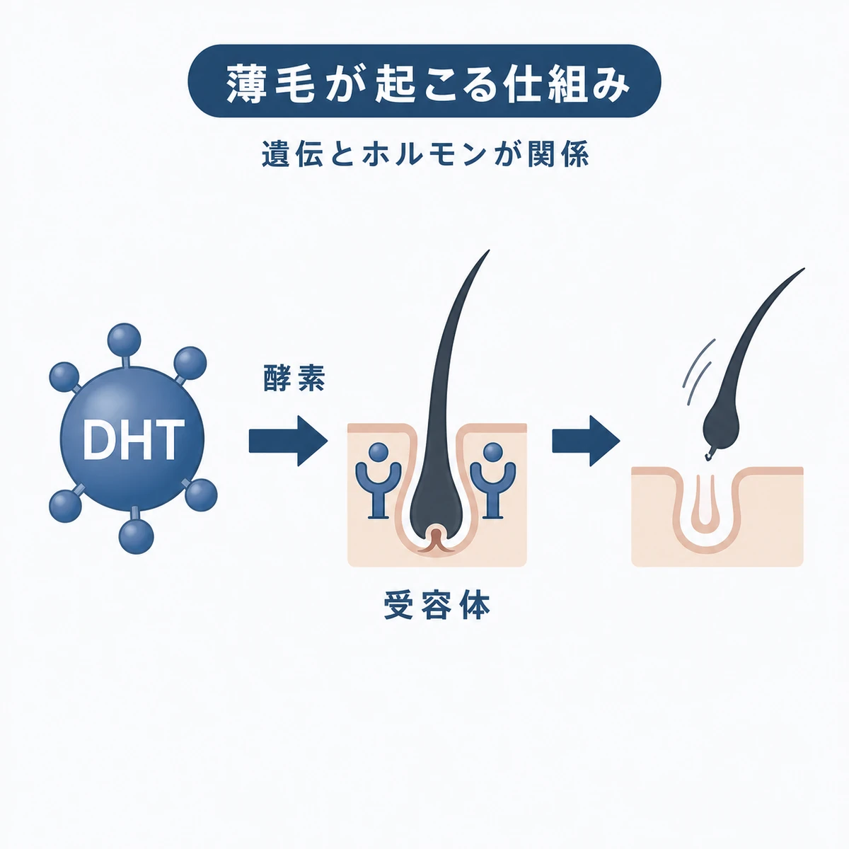 男性ホルモンから生成された物質が毛根に作用して抜け毛が進む流れを表した医療イラスト