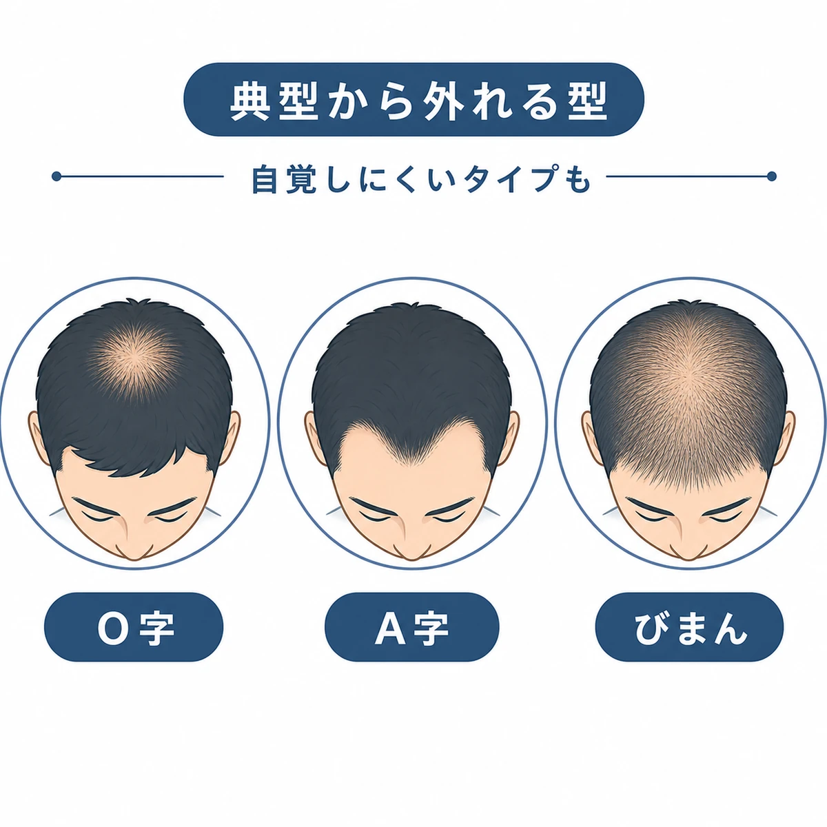 頭頂型・前方型・びまん性の3つの変則的な薄毛パターンを並べて比べた医療イラスト