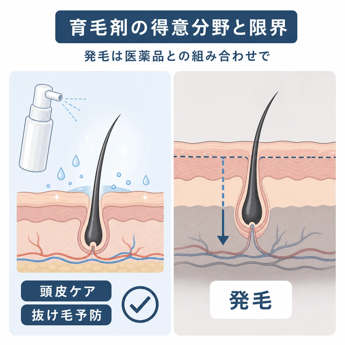 育毛剤の得意な領域と届きにくい領域を対比した医療イラスト