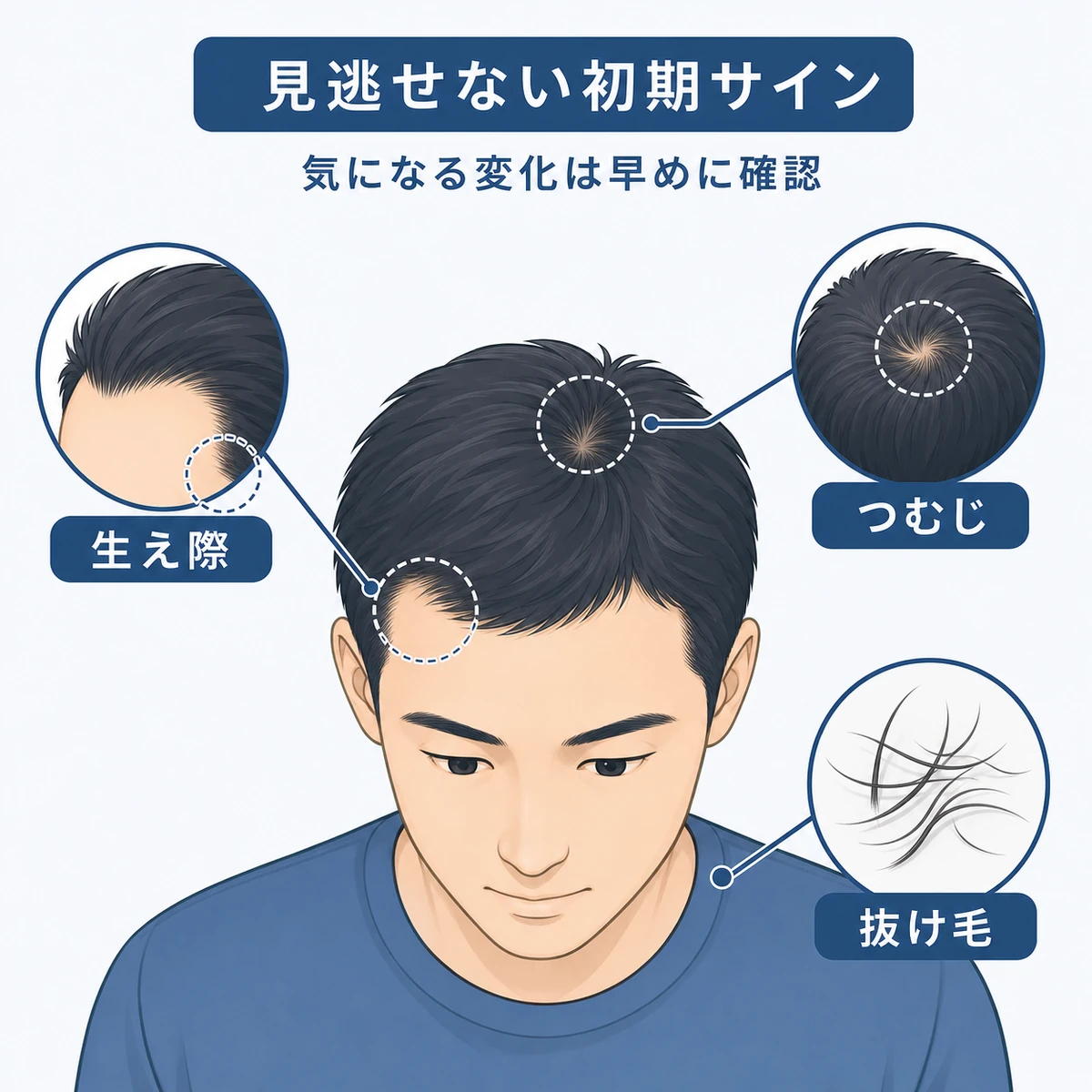 薄毛の初期サインを生え際やつむじでチェックする頭部の医療イラスト