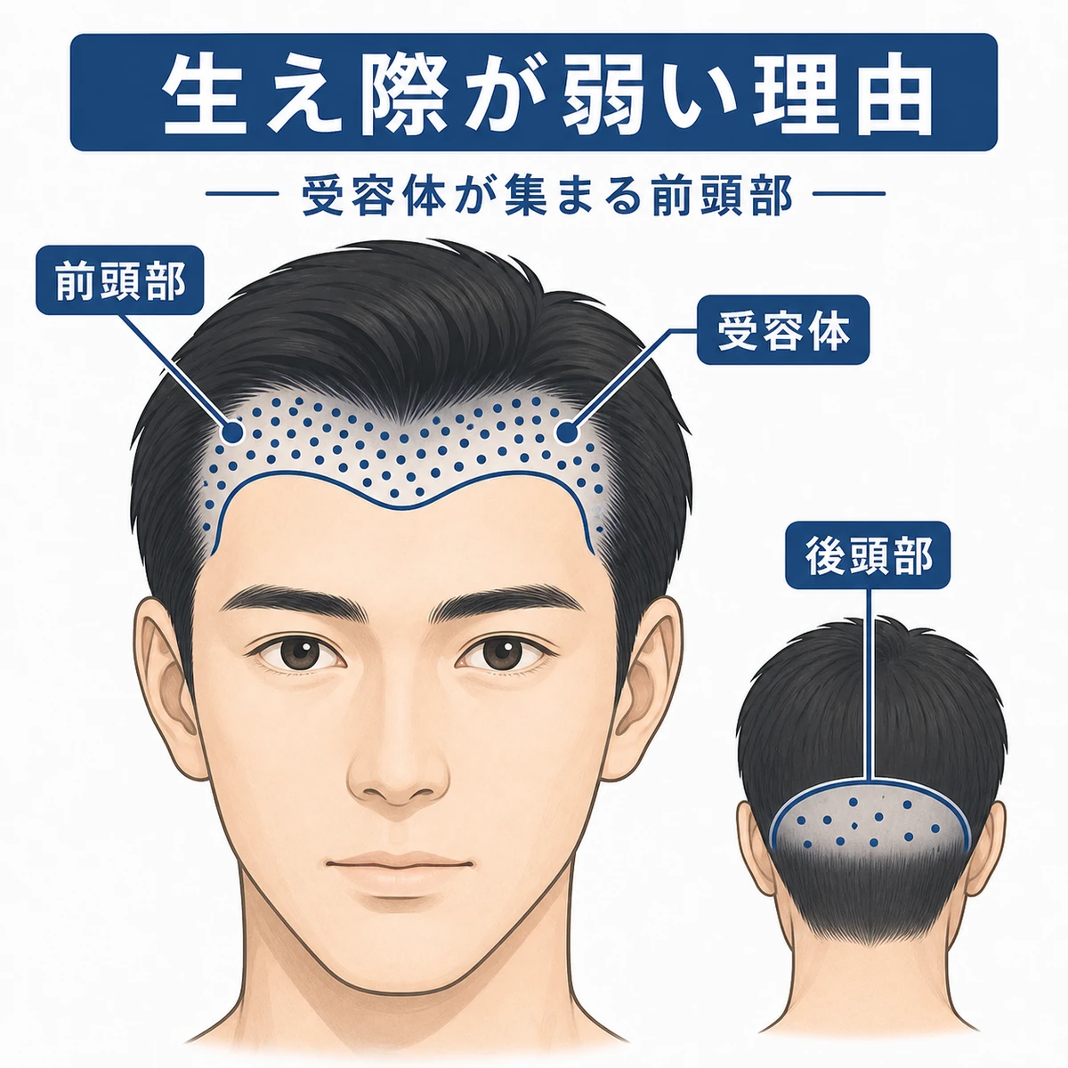 前頭部にアンドロゲン受容体が集中する分布を示した成人男性の頭部の医療イラスト
