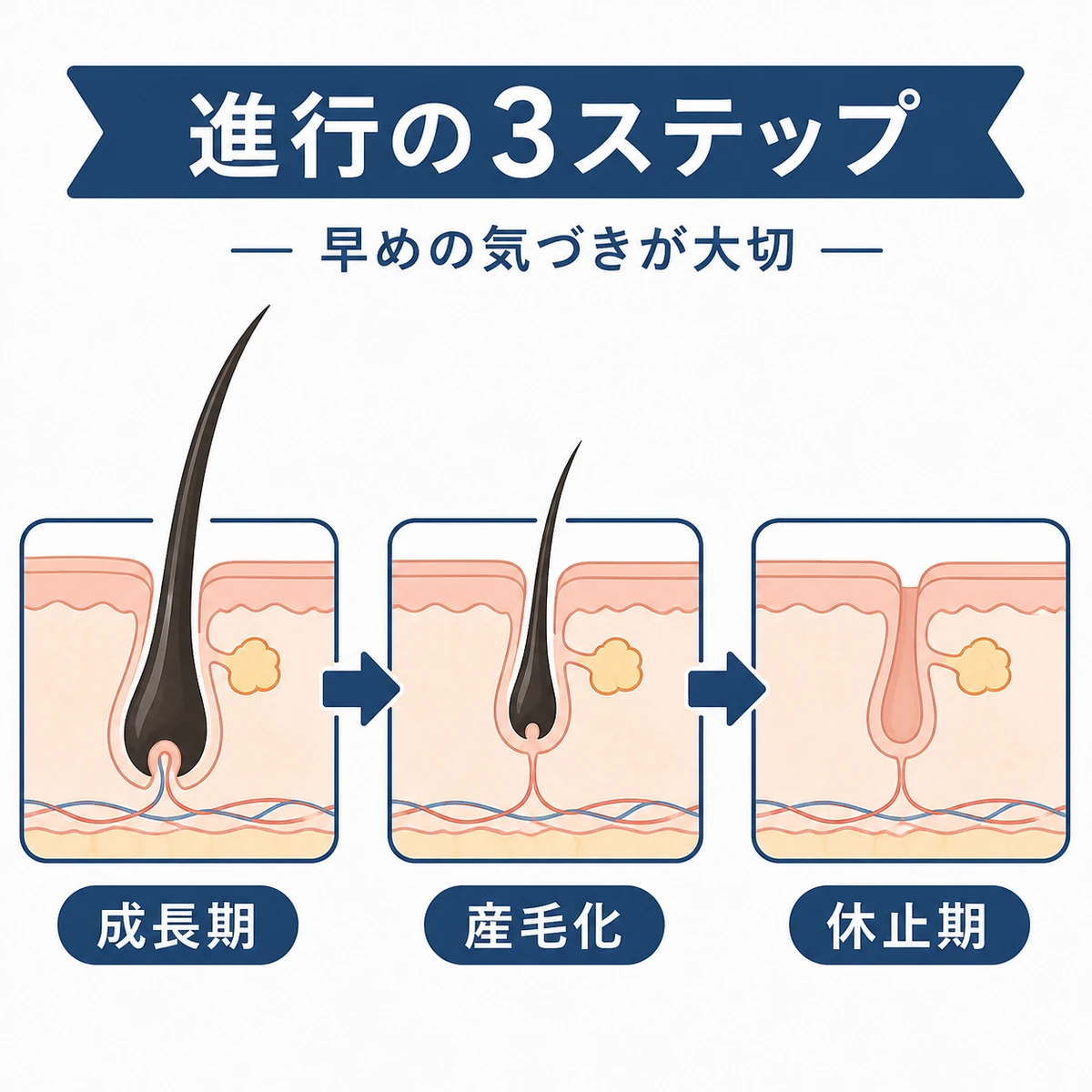 髪が太い状態から産毛になり抜け落ちるまでの進行段階を示した医療イラスト