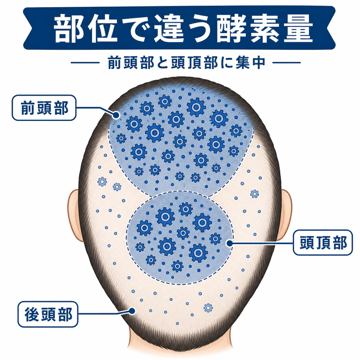 頭部の部位ごとに5αリダクターゼII型の分布が異なることを示した医療イラスト