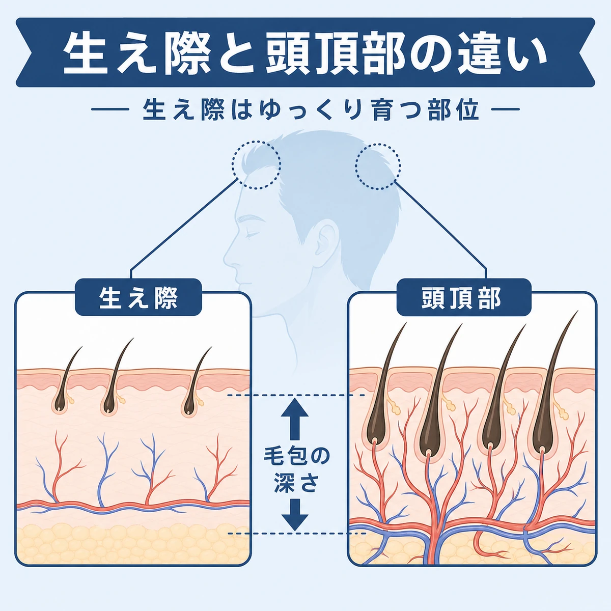 生え際と頭頂部の頭皮構造を左右で比べた医療イラスト