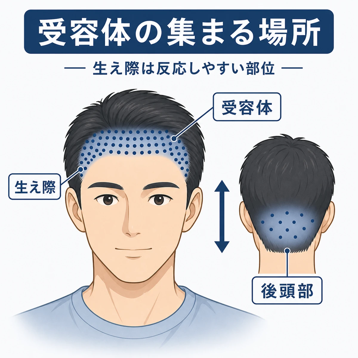 前頭部に多く集まる男性ホルモン受容体の密度差を描いた医療イラスト