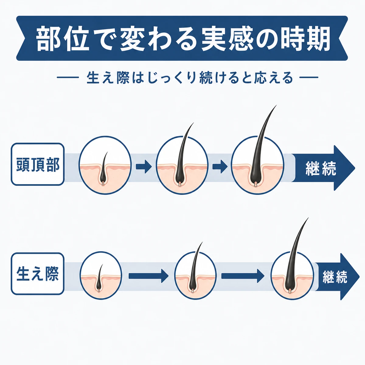 頭頂部と生え際で実感までの時間が異なる流れを描いた医療イラスト