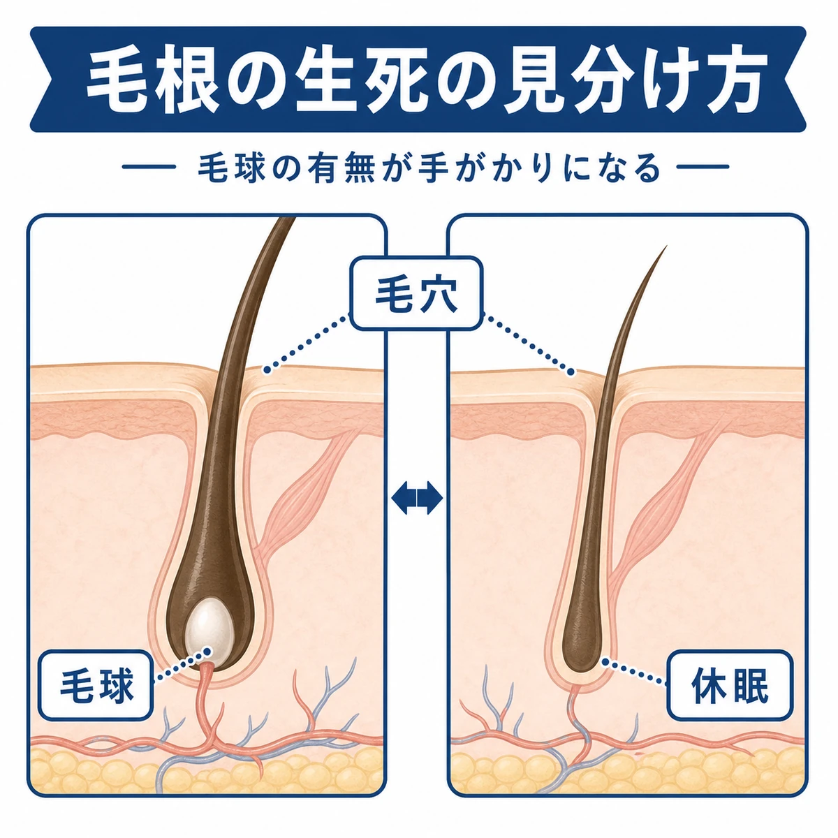 抜け毛の根元の毛球から毛根が元気か休眠かを見分ける様子を表した医療イラスト