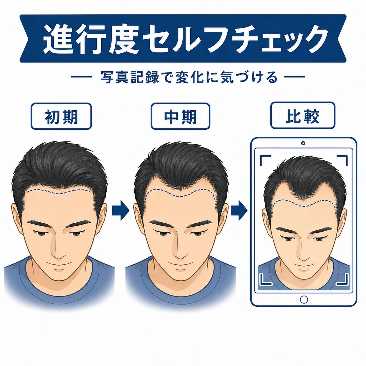 成人男性の生え際が段階的に変化する進行度を鏡や写真で確かめる流れを表した医療イラスト