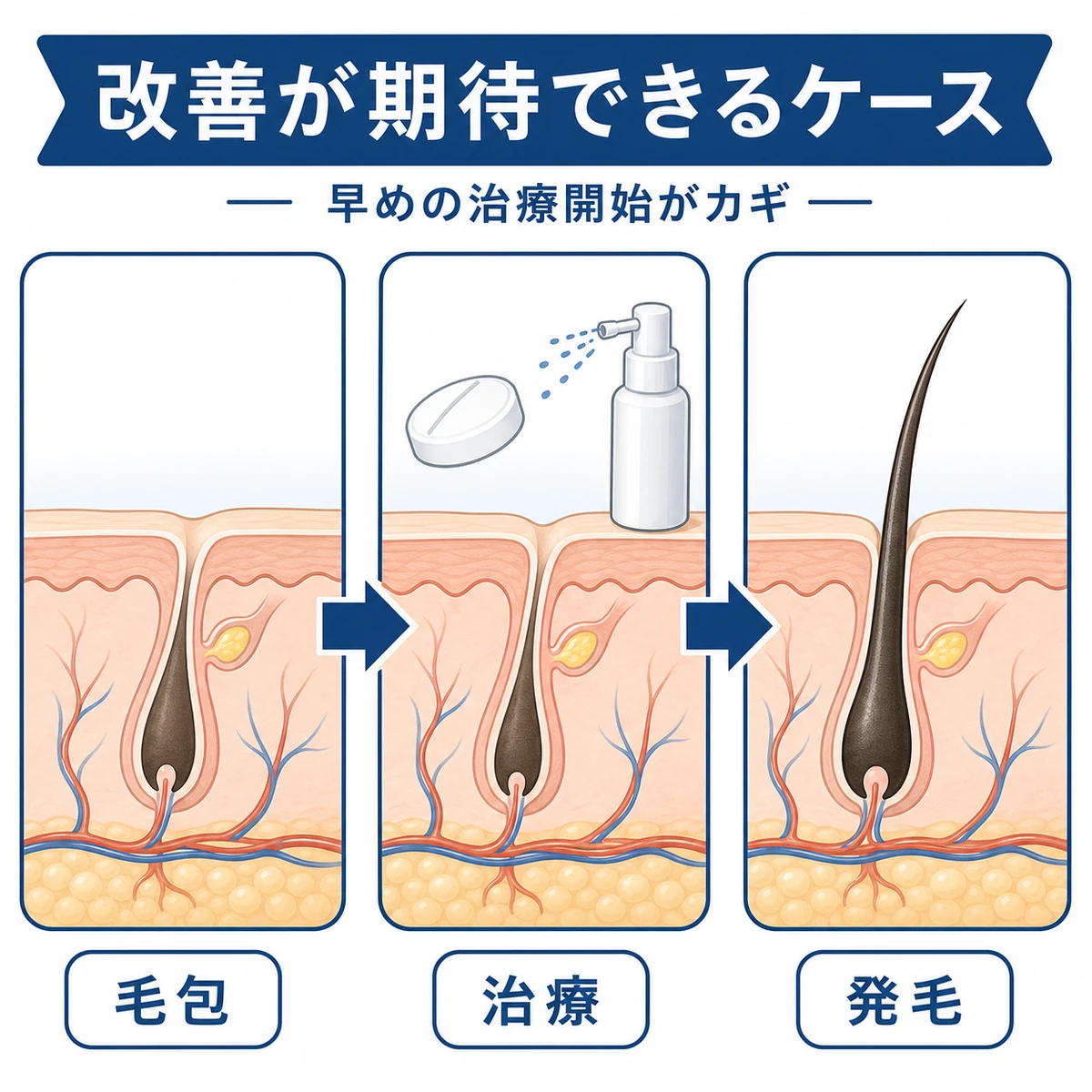 残った毛包が治療を経て発毛へ向かう流れを表した医療イラスト