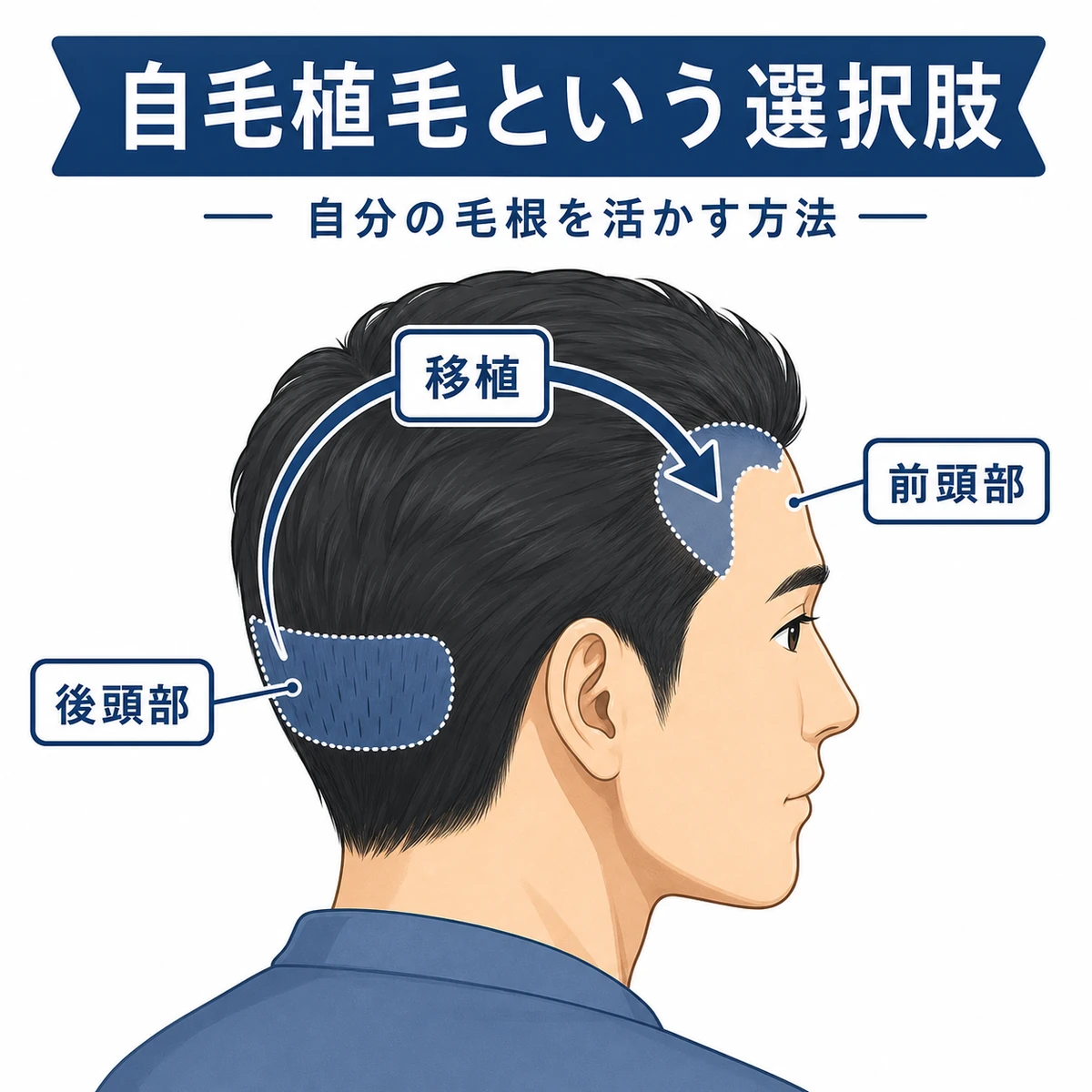 成人男性の後頭部の毛根を前頭部のM字部分へ移す自毛植毛の流れを表した医療イラスト