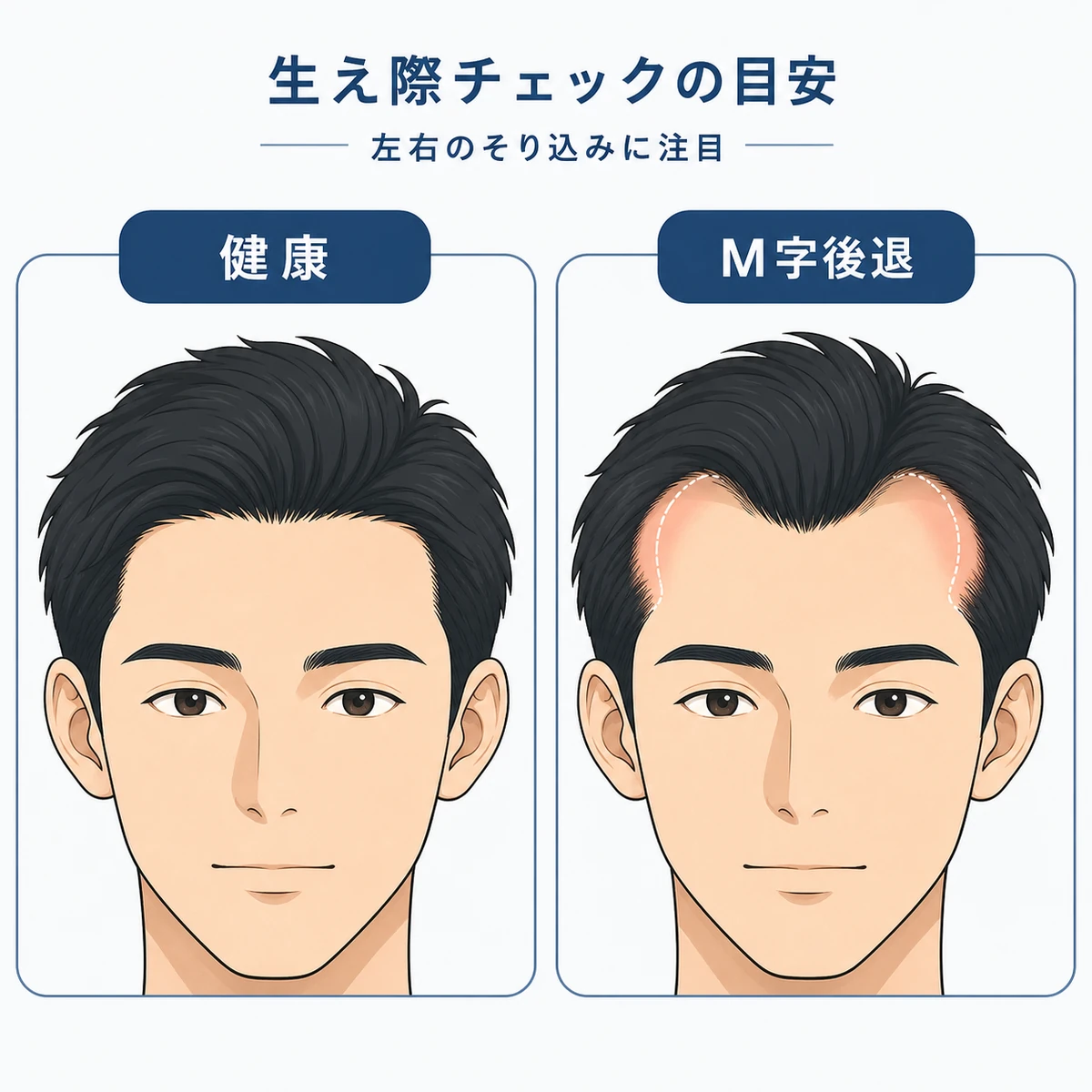 健康な生え際とM字型に後退した生え際を並べて見比べる20代男性の医療イラスト