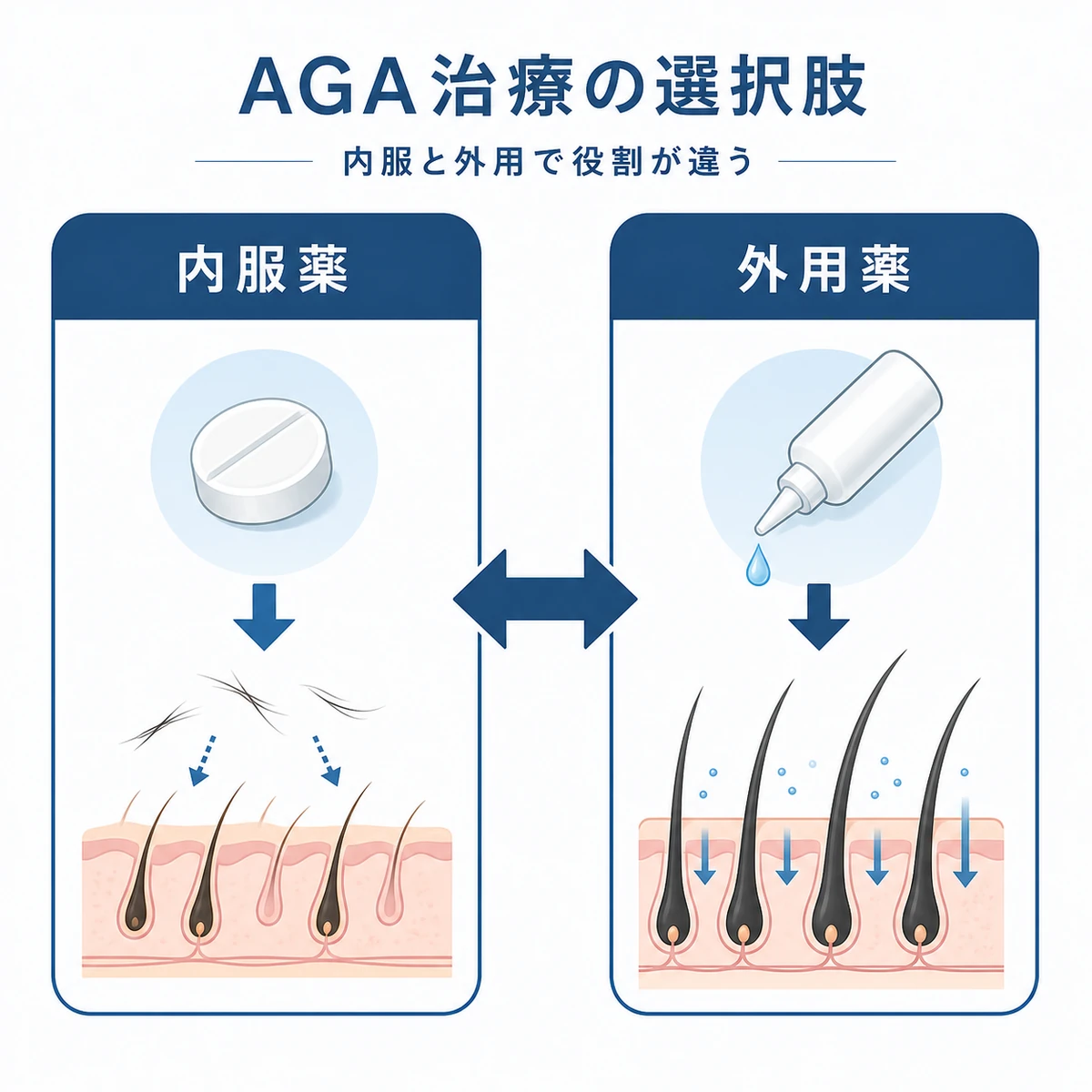 抜け毛を抑える内服薬と発毛を促す外用薬の役割の違いを並べたAGA治療の医療イラスト