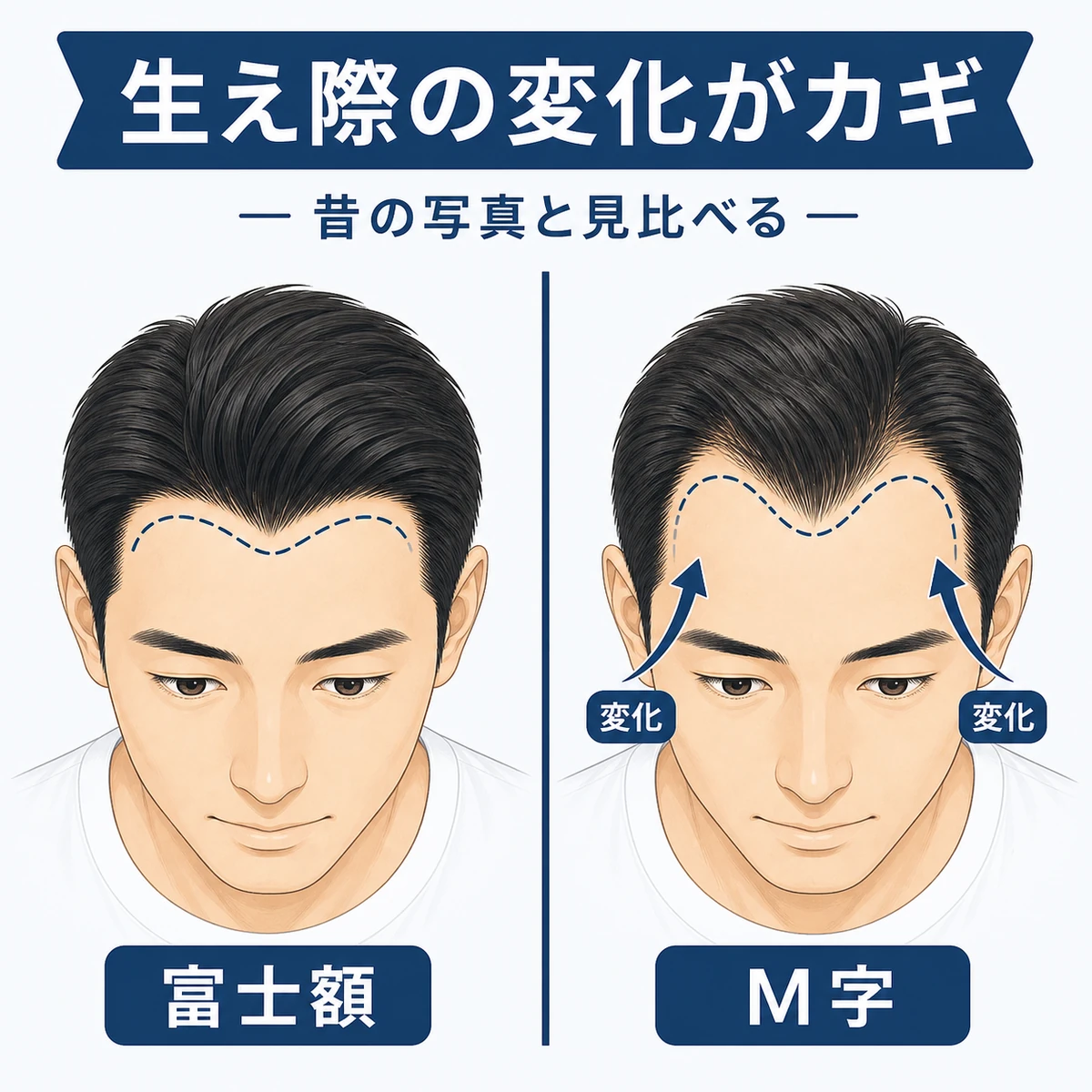 富士額とM字はげの生え際の違いを左右で比べた医療イラスト