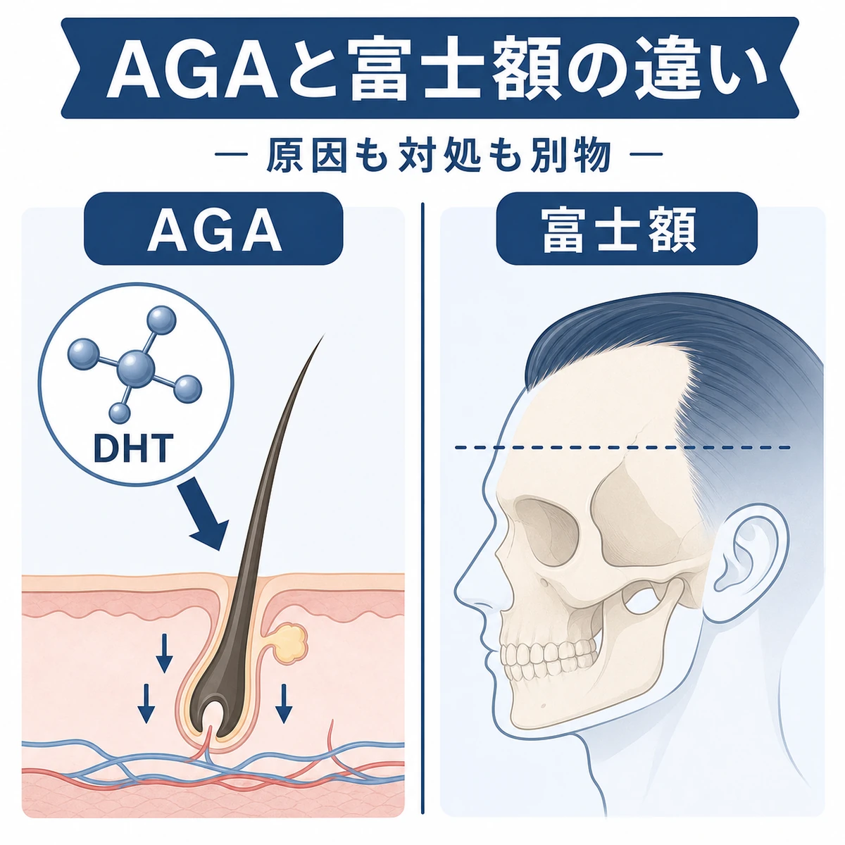 AGAと富士額の原因の違いを対比した医療イラスト