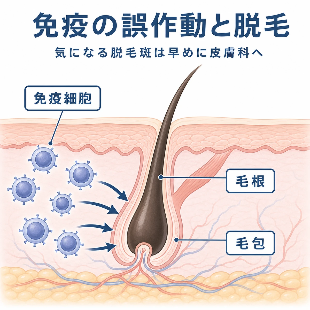 免疫細胞が毛根を攻撃して脱毛が始まるしくみを表した医療イラスト