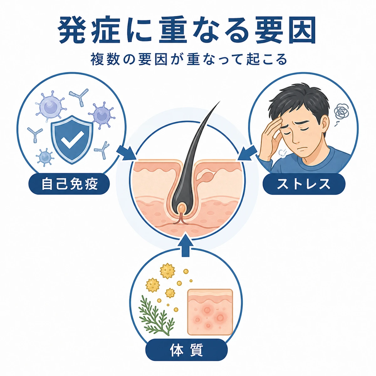自己免疫やストレスなど円形脱毛症の発症に関わる要因を集めた相関図の医療イラスト