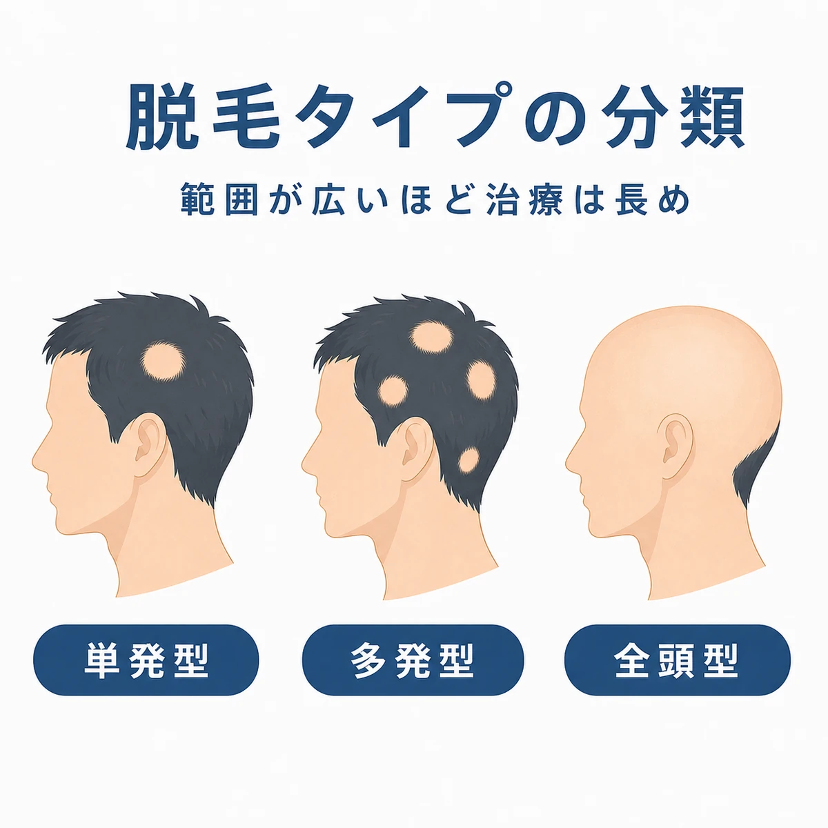 単発型から全頭型まで円形脱毛症の種類を頭部のシルエットで比べた医療イラスト