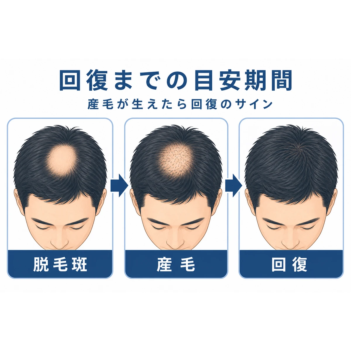 脱毛斑から産毛が生えて回復へ向かう経過を段階で表した医療イラスト