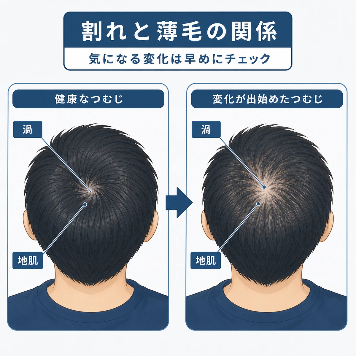 健やかなつむじと変化が出始めたつむじを左右で見比べた医療イラスト