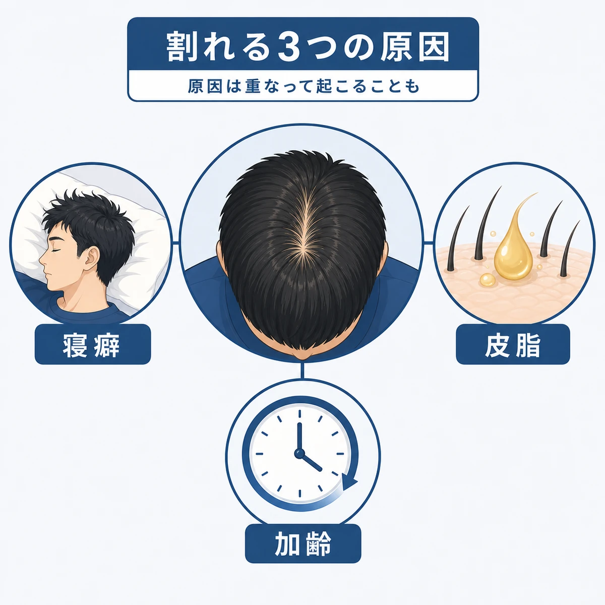 つむじが割れる主な3つの原因を中心から枝分かれで表した医療イラスト