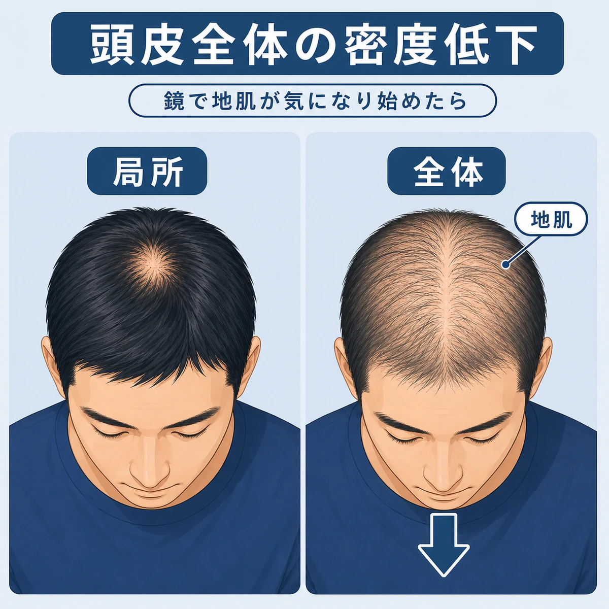 男性の頭部全体で髪の密度が低下する特徴を局所的な薄毛と並べて表した医療イラスト