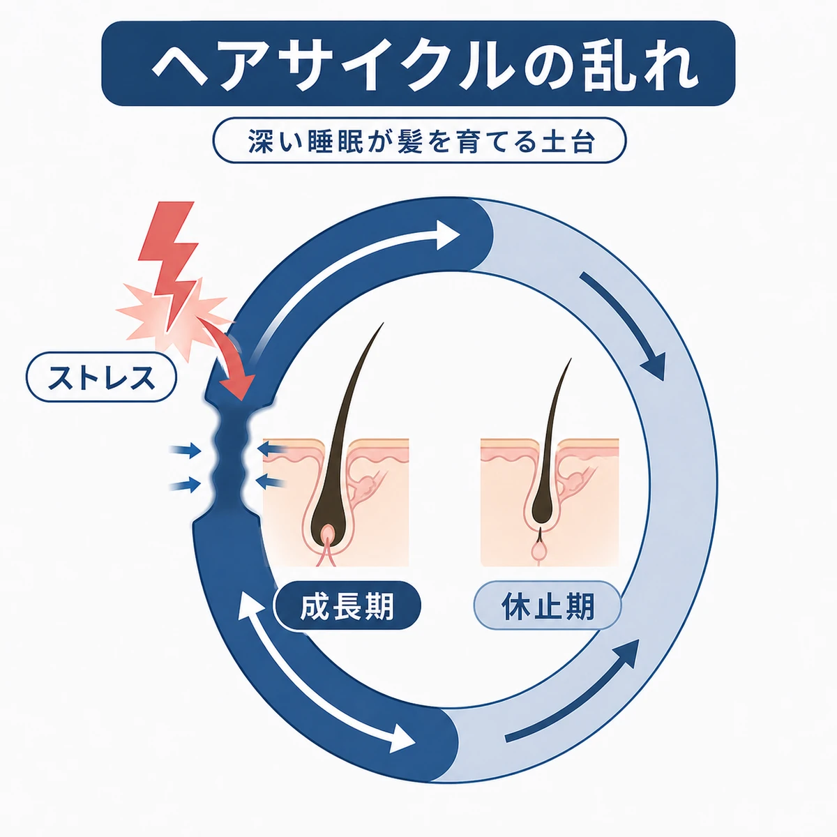 ストレスによって髪の成長期が短くなりヘアサイクルが乱れる流れを表した医療イラスト
