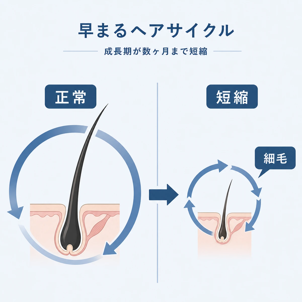 健康な髪と若ハゲで短くなったヘアサイクルを左右で比べた医療イラスト