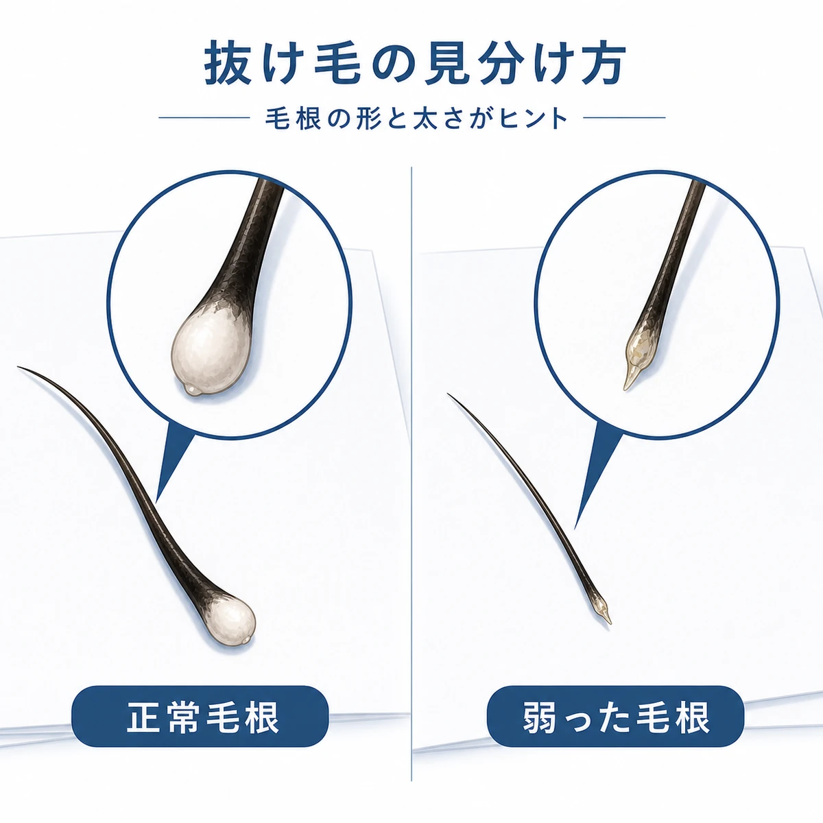 正常な抜け毛と若ハゲの抜け毛の毛根を拡大して対比した医療イラスト