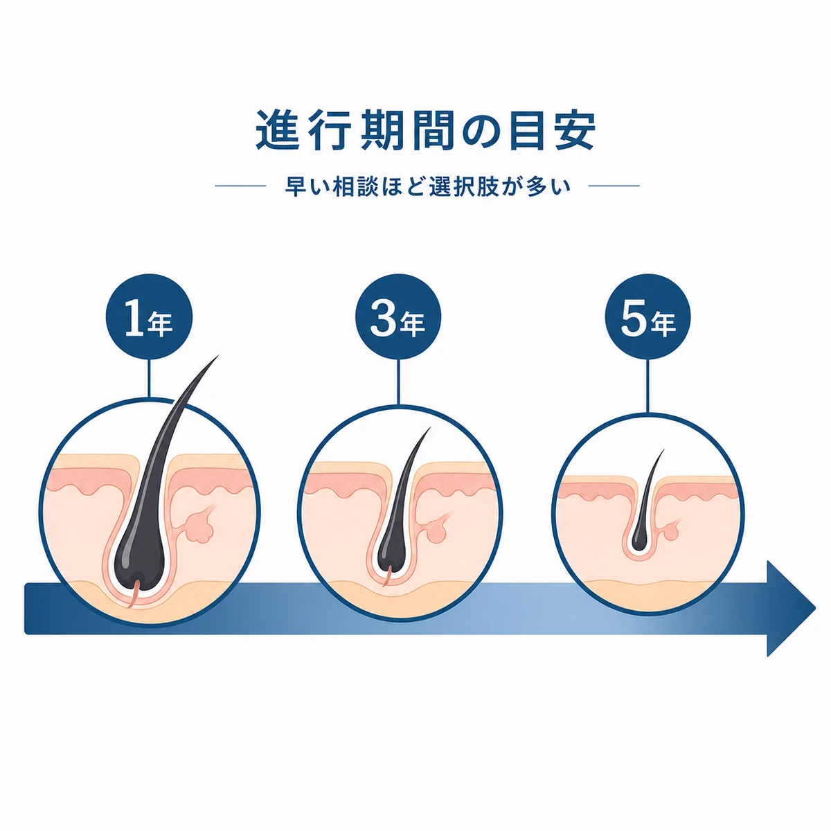 薄毛を放置した経過期間と回復しやすさの変化を矢印で示した医療イラスト