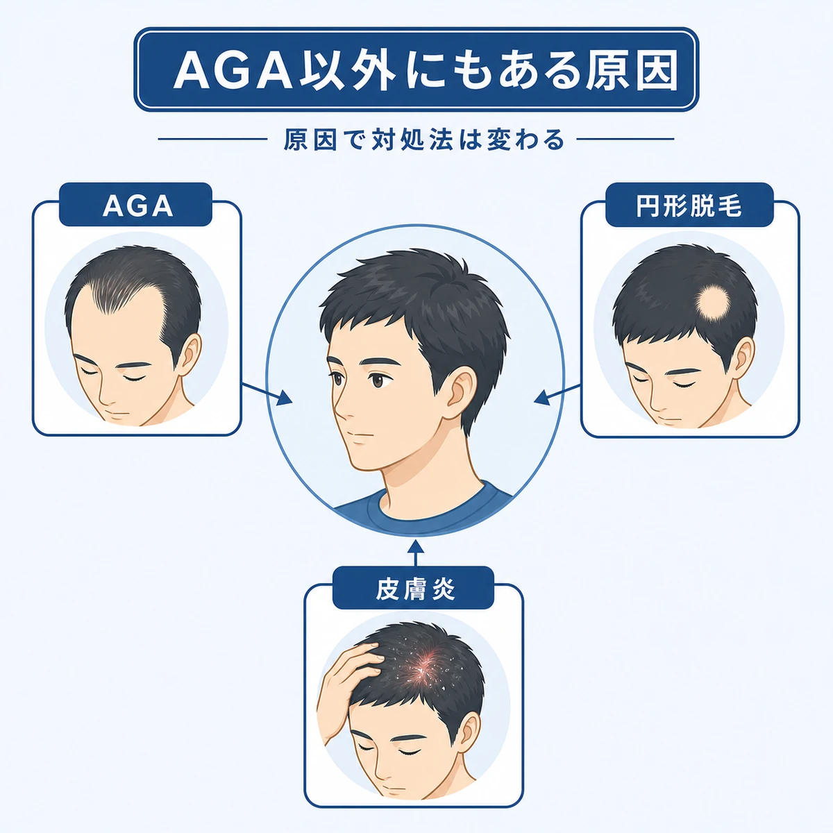 AGAや円形脱毛症など男性の抜け毛を招くいくつかの原因を頭部から放射状に示した医療イラスト