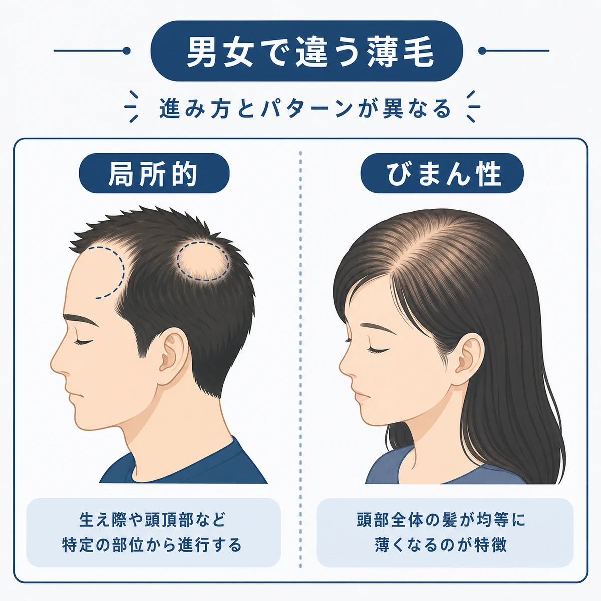 男性の局所的な薄毛と女性のびまん性の薄毛の違いを表した医療イラスト