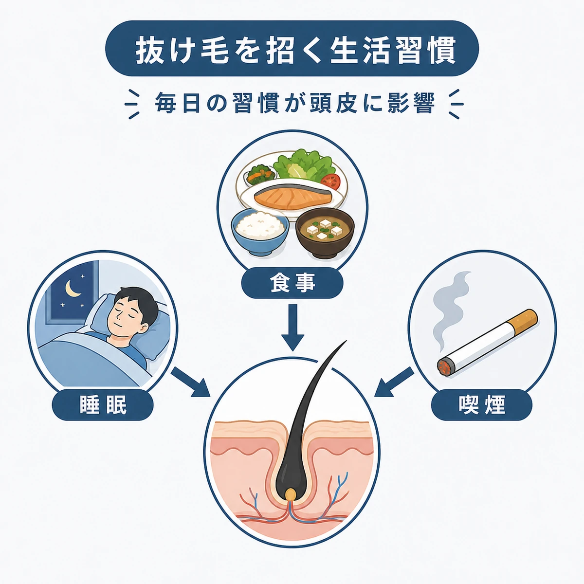睡眠や食事、喫煙などの生活習慣が抜け毛を加速させる関係を表した医療イラスト