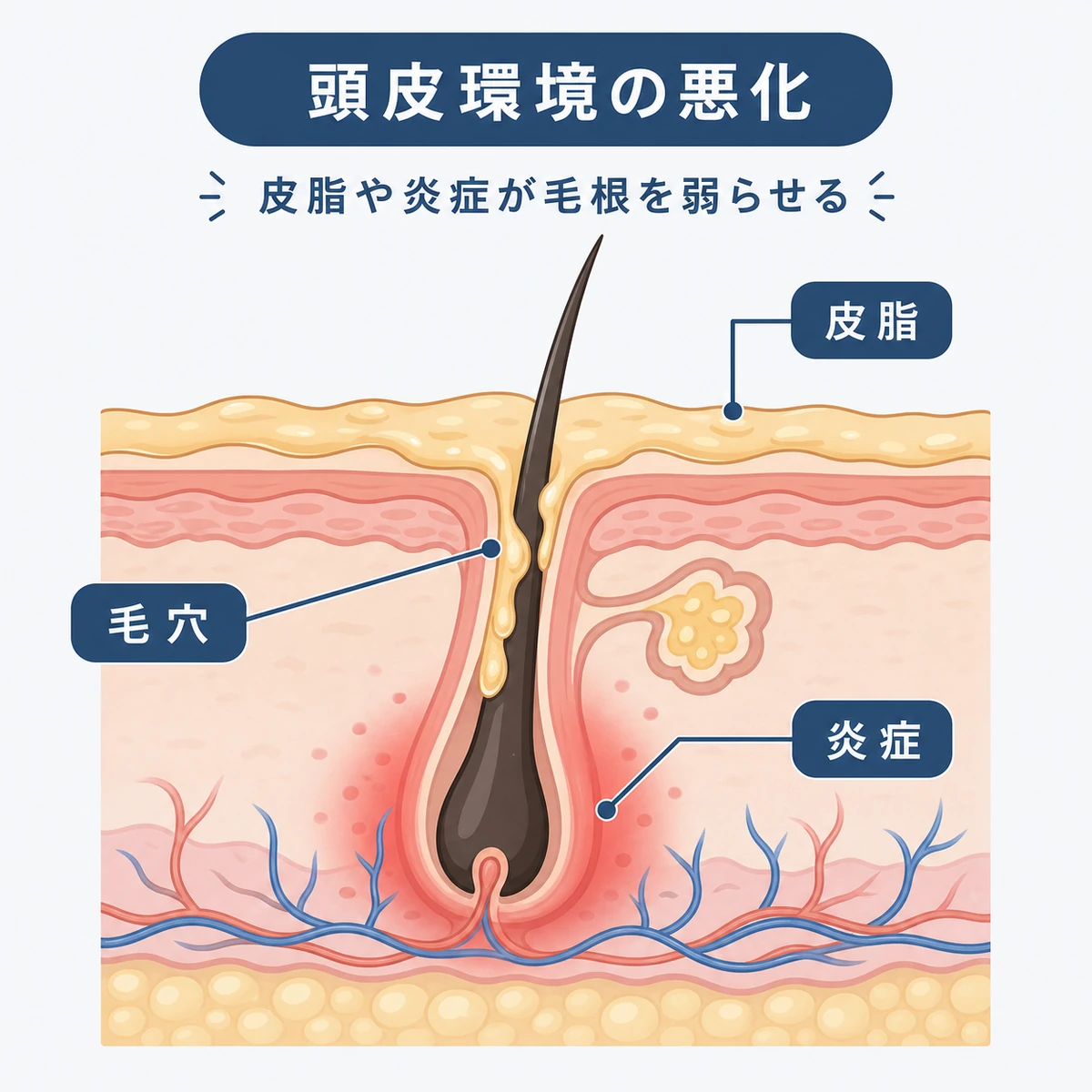 皮脂の過剰や毛穴の詰まり、炎症が毛根を傷める頭皮の断面を表した医療イラスト
