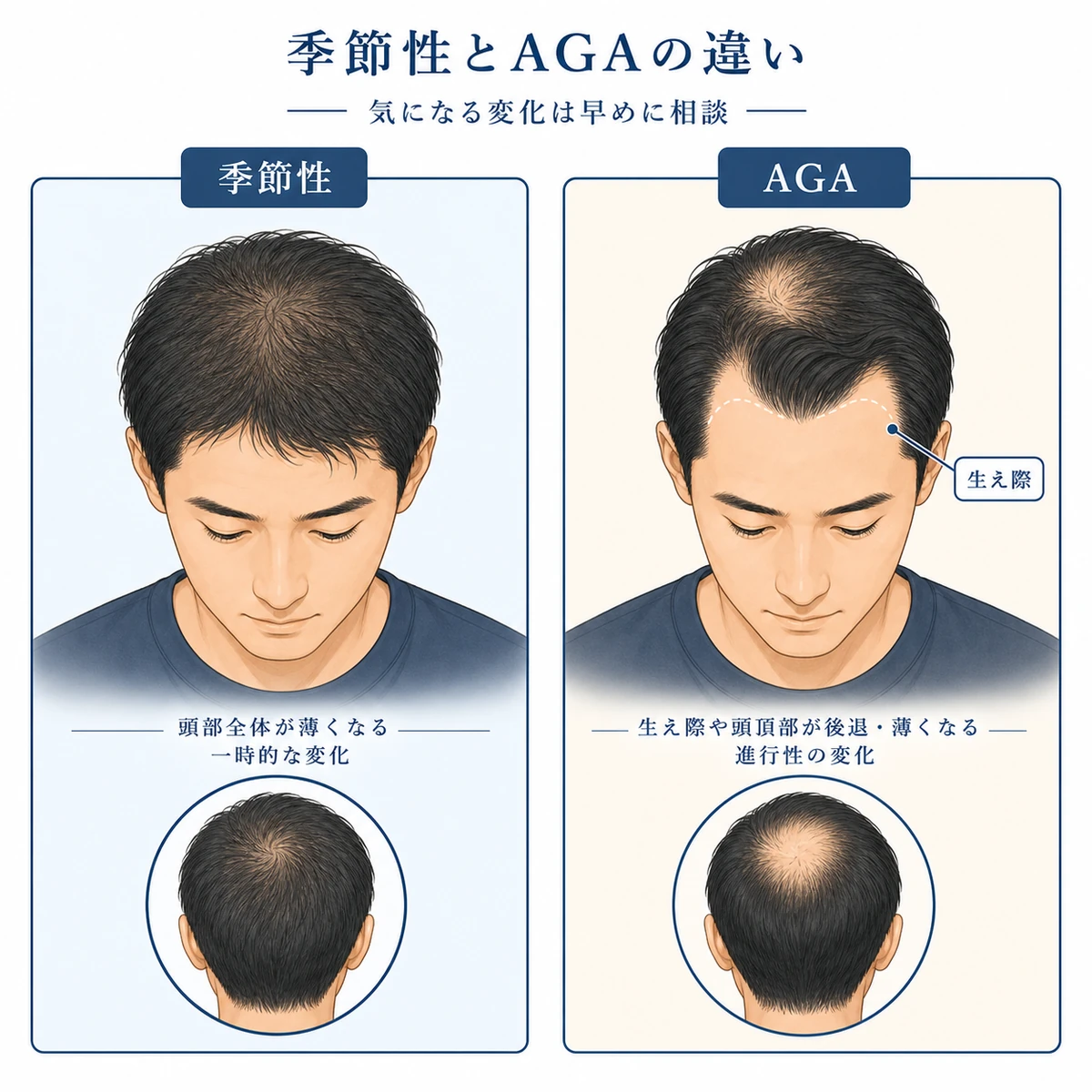 季節性の抜け毛とAGAの進行部位の違いを成人男性の頭部で比べた医療イラスト