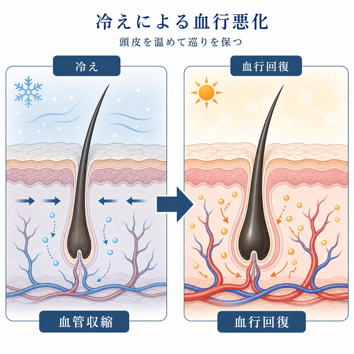 頭皮の冷えで毛細血管が収縮し栄養が届きにくくなる変化を左右で対比した医療イラスト