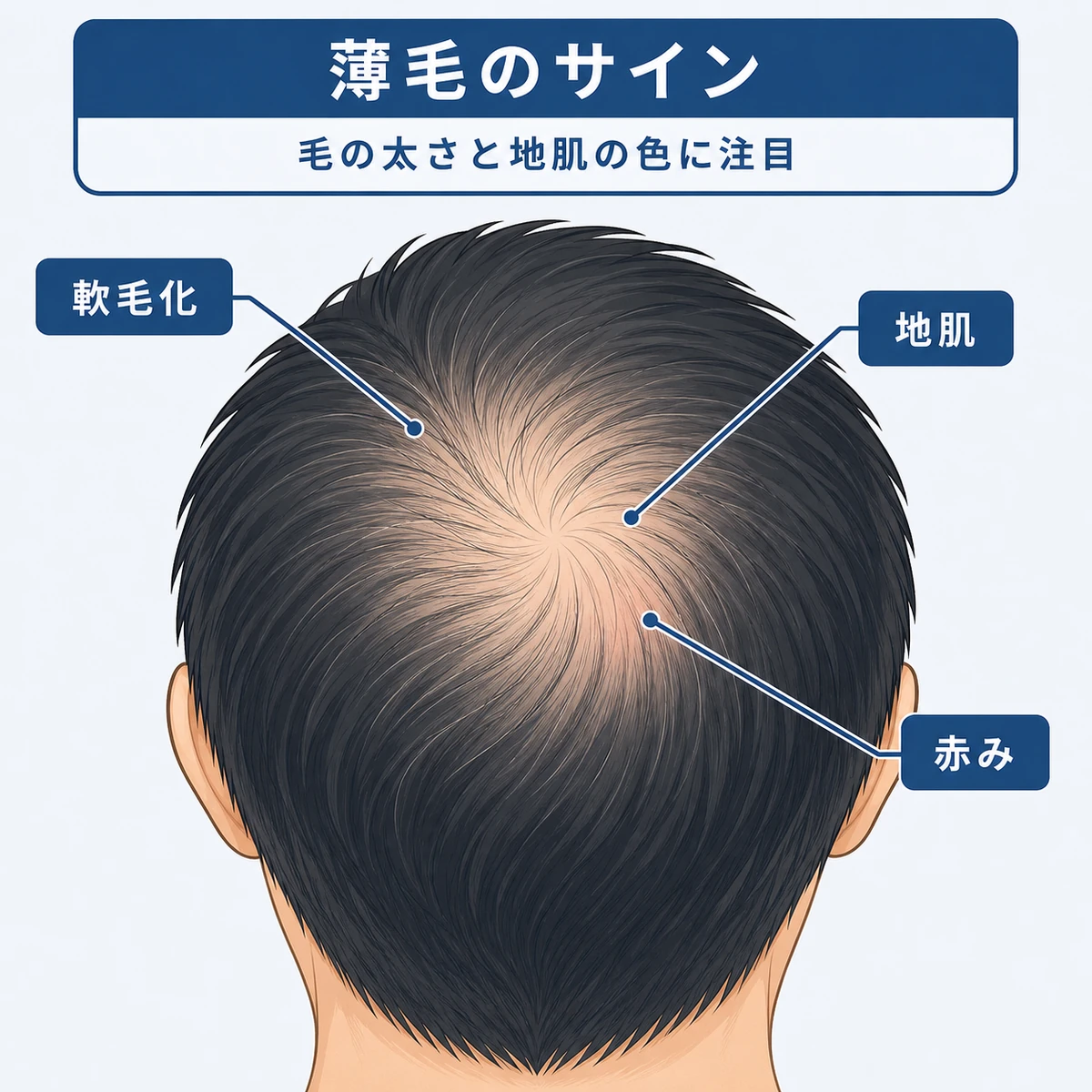撮影画像から読み取る軟毛化や地肌の広がりなど薄毛のサインを頭頂部の俯瞰図で表した医療イラスト